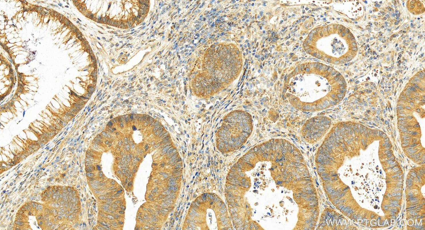 IHC staining of human colon cancer using 10575-1-AP