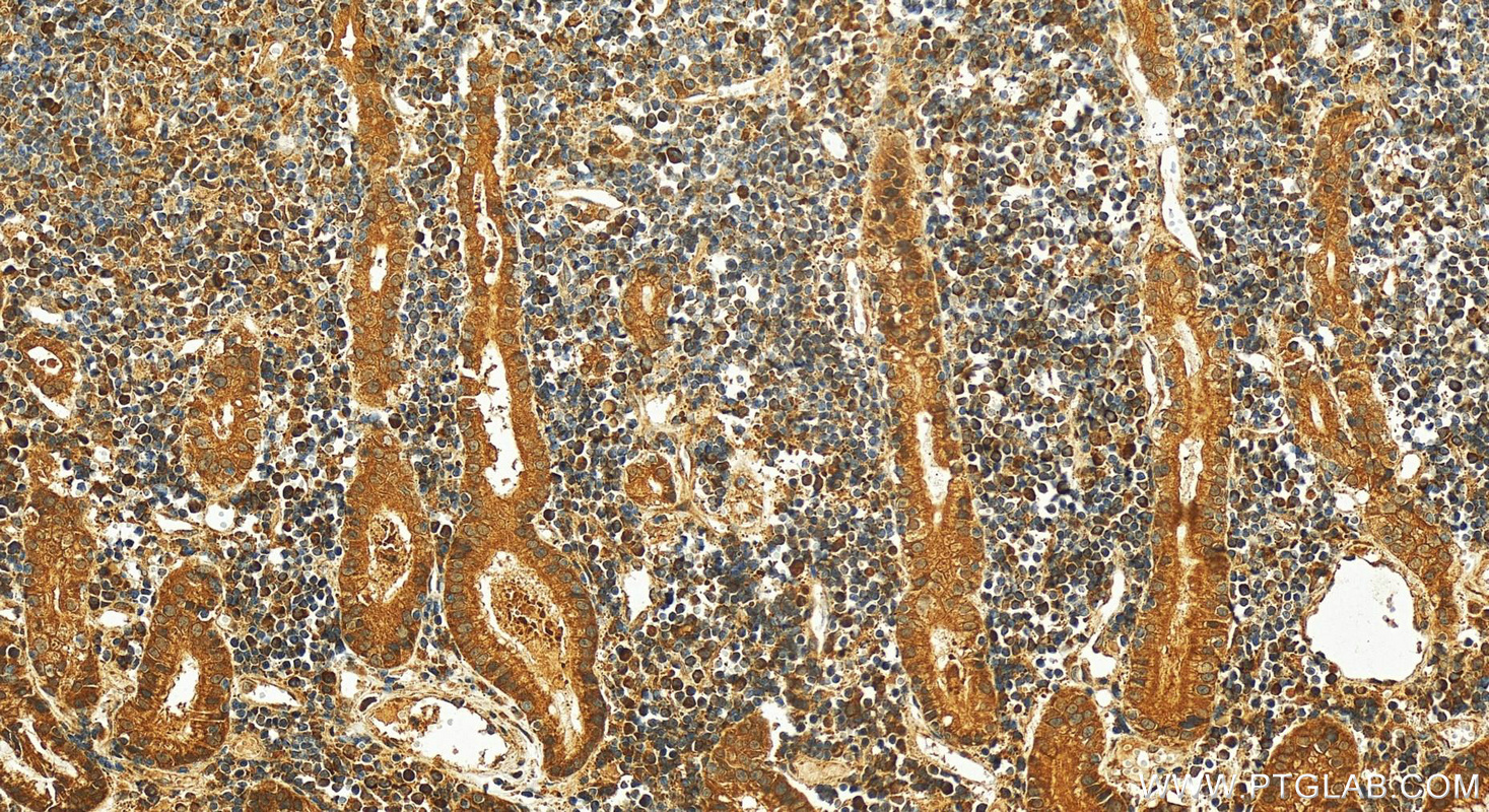 IHC staining of human stomach cancer using 10575-1-AP