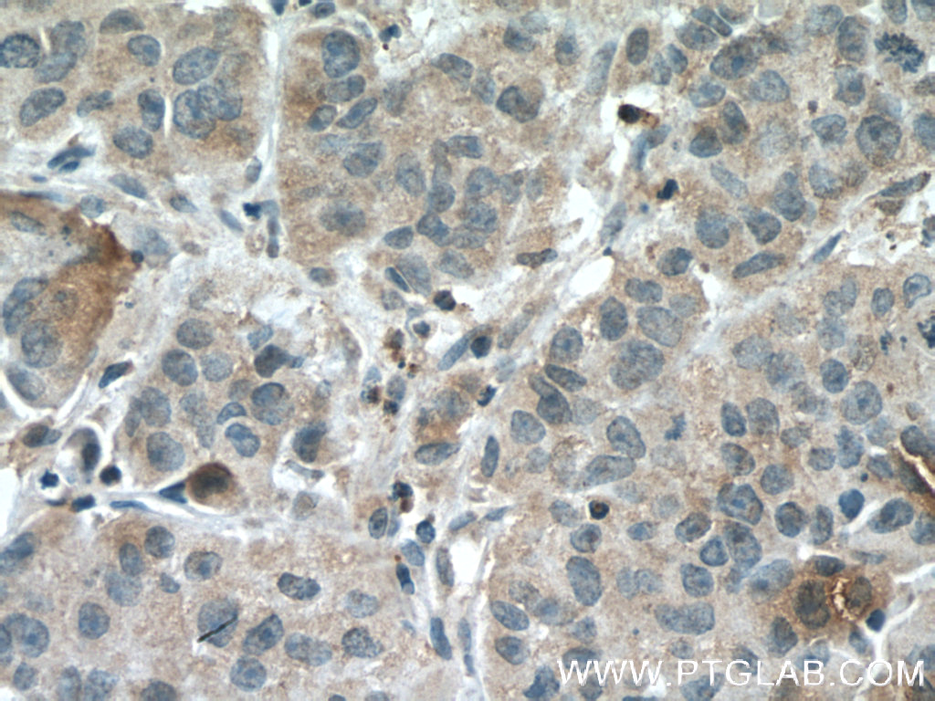 IHC staining of human prostate cancer using 66438-1-Ig (same clone as 66438-1-PBS)