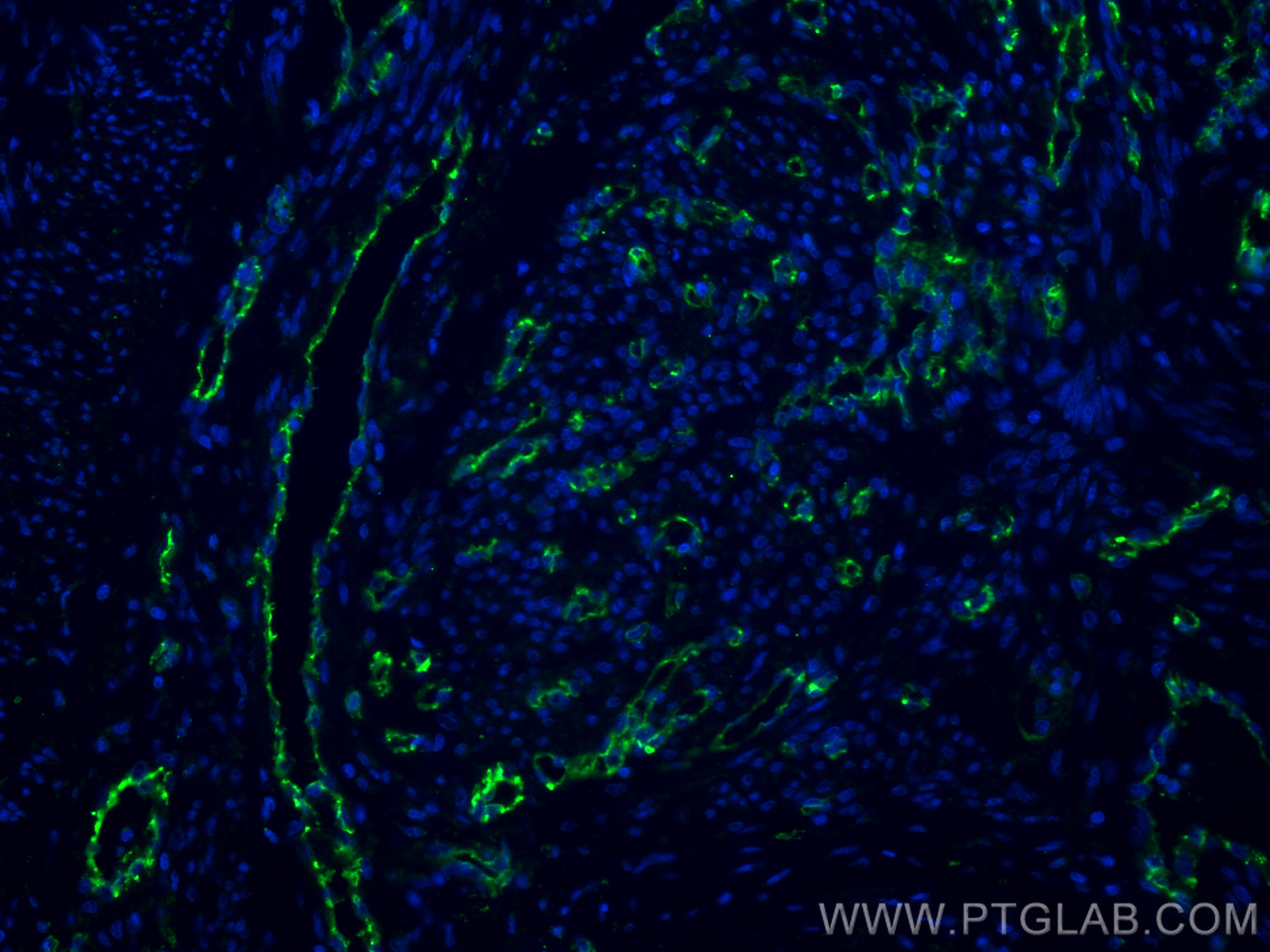 IF Staining of human endometrial cancer using 11265-1-AP