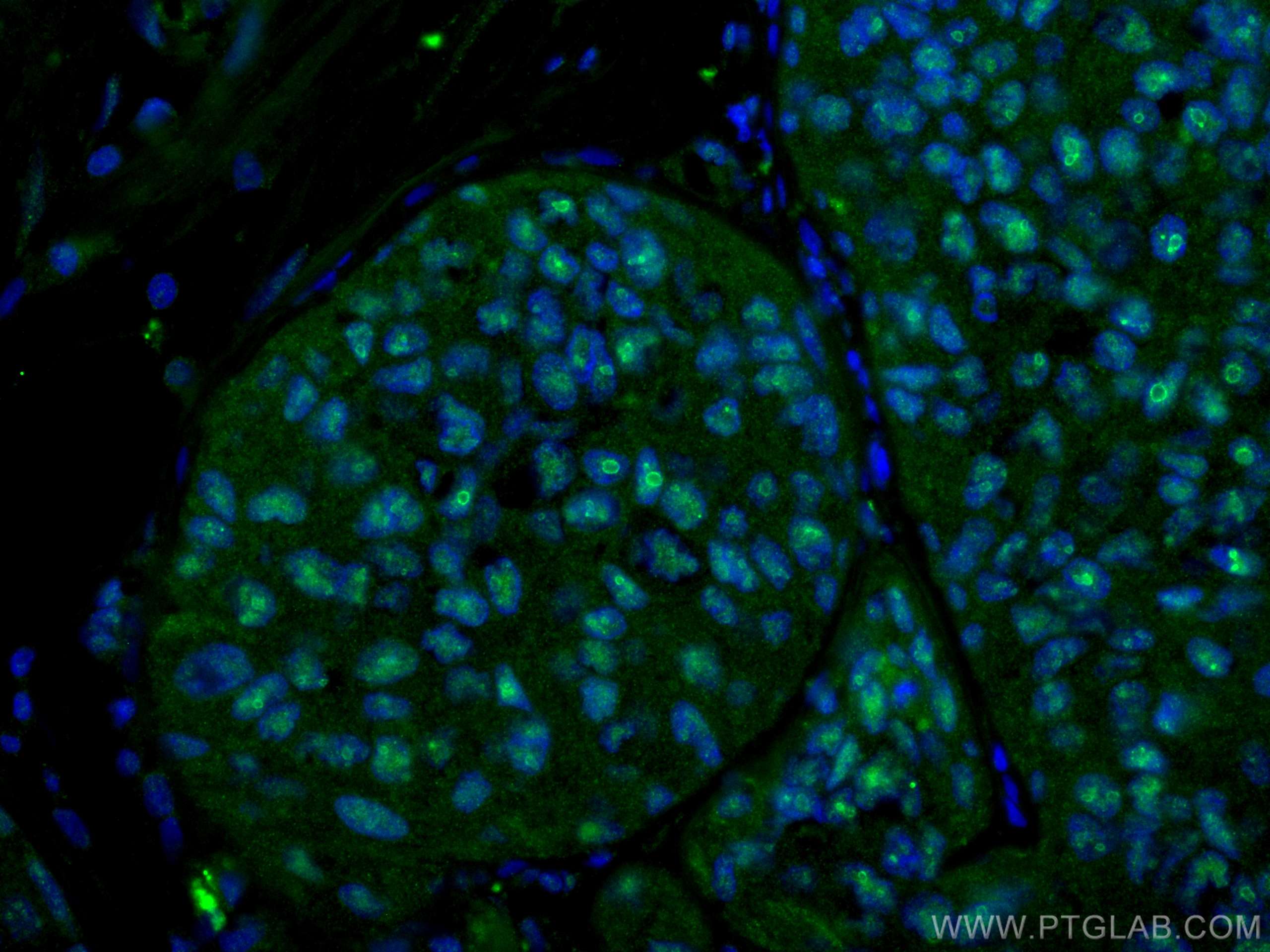 IF Staining of human breast cancer using 67050-1-Ig (same clone as 67050-1-PBS)