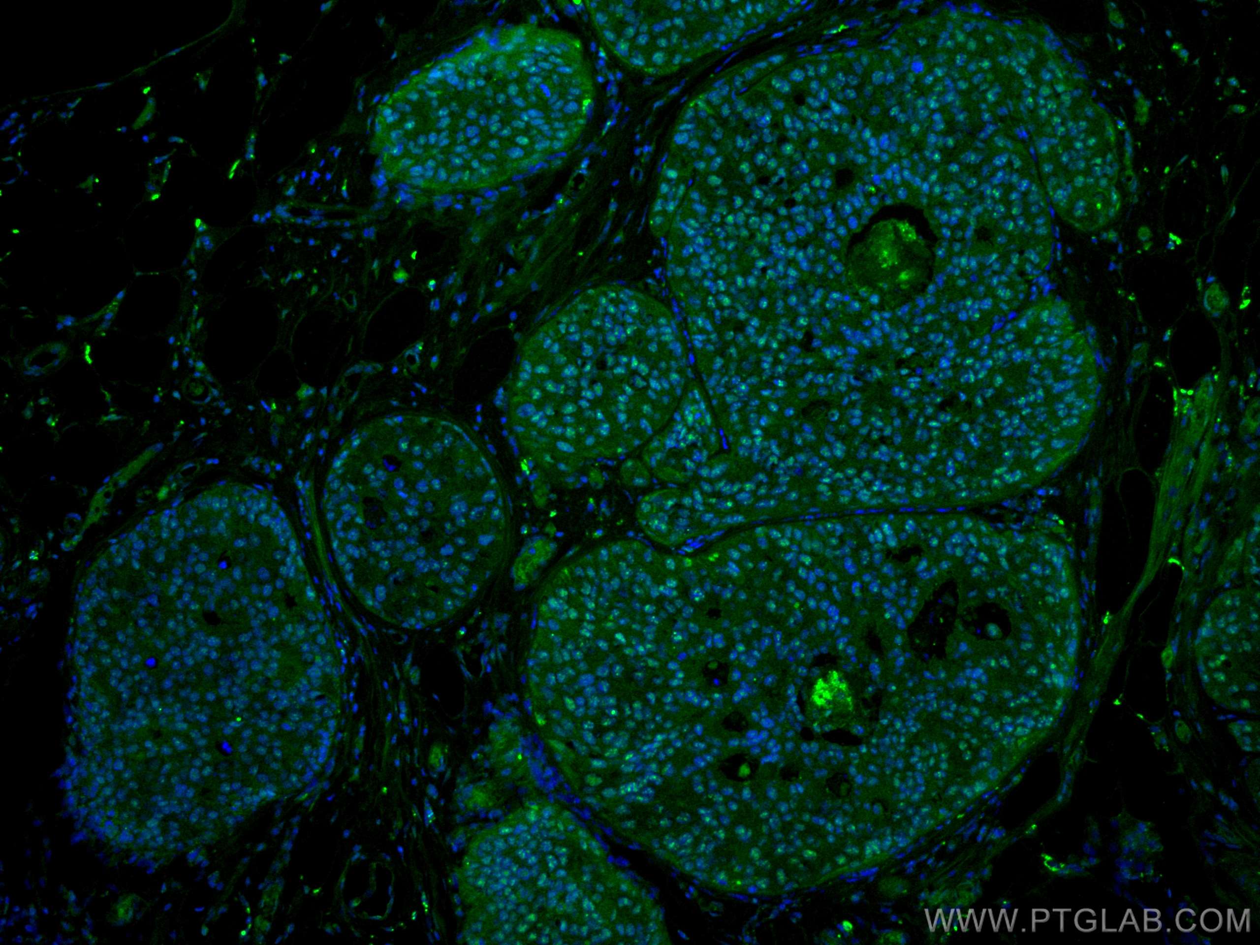 IF Staining of human breast cancer using 67050-1-Ig (same clone as 67050-1-PBS)