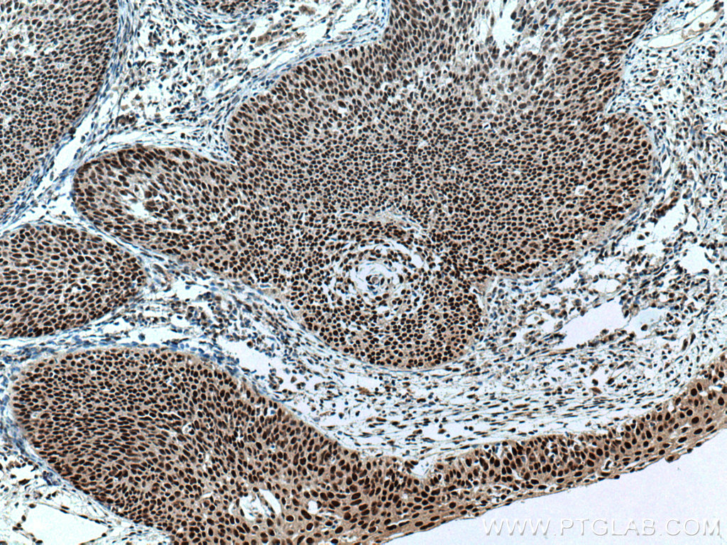 IHC staining of human cervical cancer using 67050-1-Ig (same clone as 67050-1-PBS)