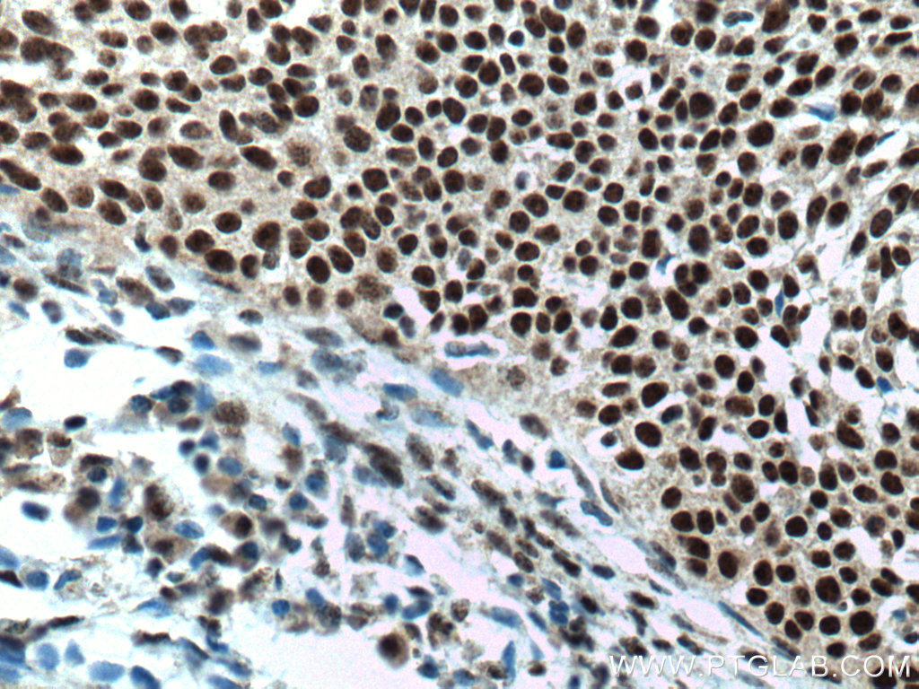 IHC staining of human cervical cancer using 67050-1-Ig (same clone as 67050-1-PBS)