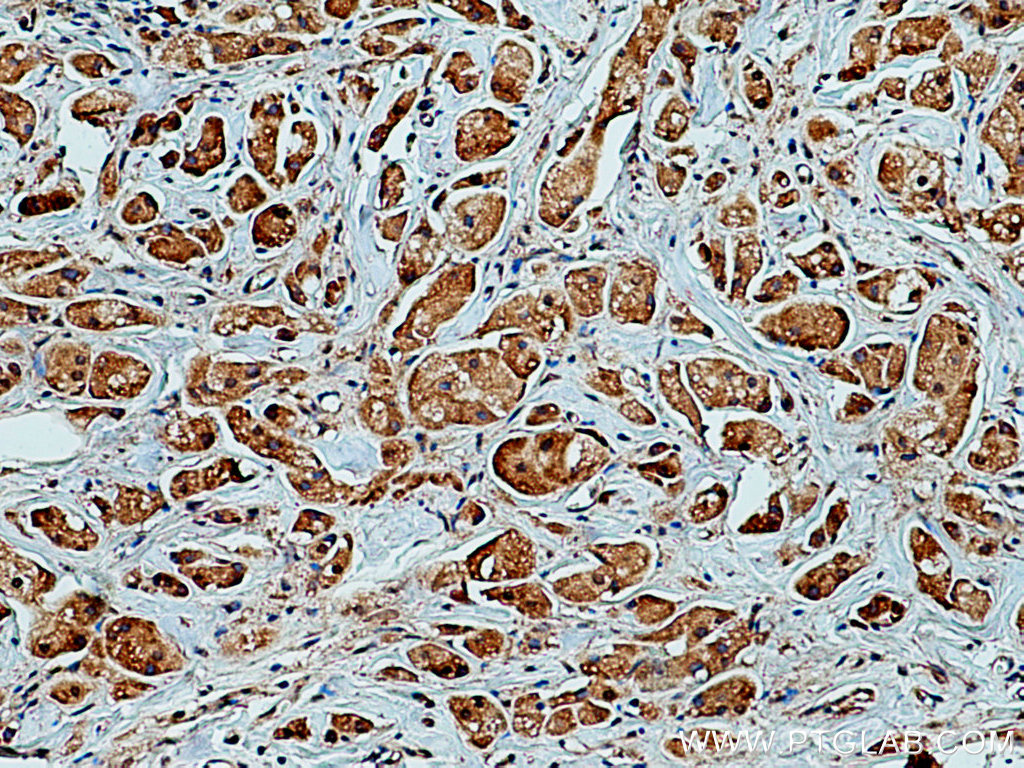 IHC staining of human breast cancer using 67202-1-Ig (same clone as 67202-1-PBS)