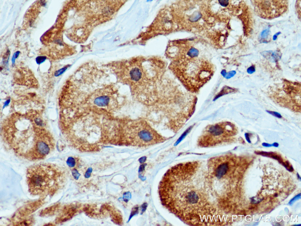 IHC staining of human breast cancer using 67202-1-Ig (same clone as 67202-1-PBS)