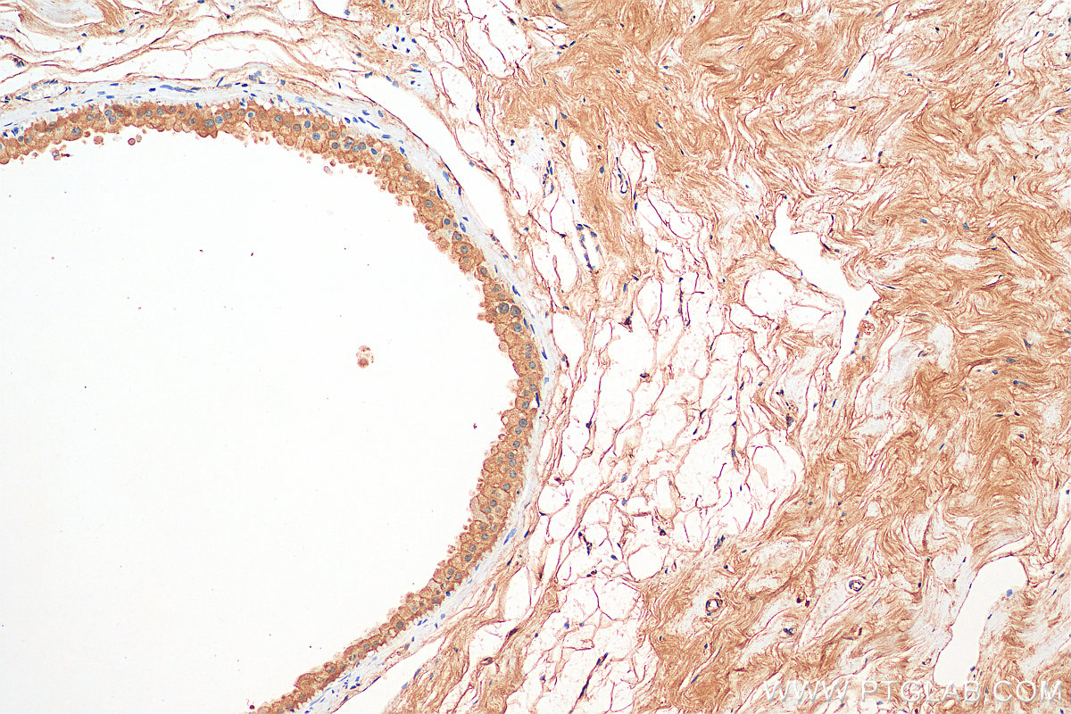 IHC staining of human breast cancer using 13463-1-AP