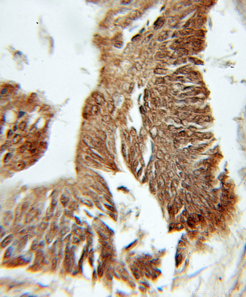 IHC staining of human colon cancer using 11033-2-AP