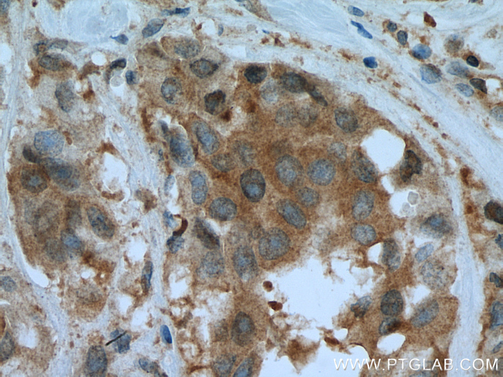 IHC staining of human breast cancer using 16045-1-AP