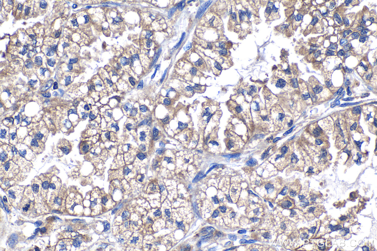 IHC staining of human lung cancer using 68385-1-Ig (same clone as 68385-1-PBS)