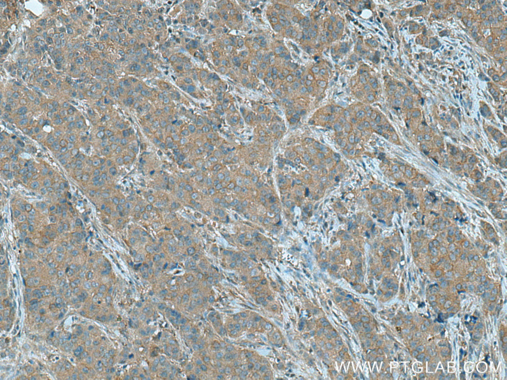 IHC staining of human breast cancer using 15550-1-AP