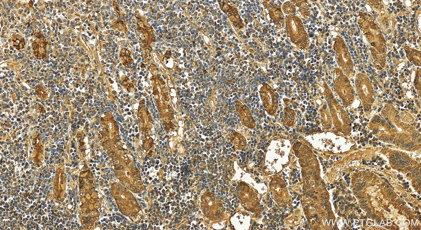 IHC staining of human stomach cancer using 16881-1-AP