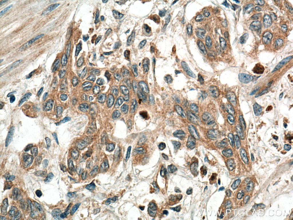 IHC staining of human stomach cancer using 28532-1-AP