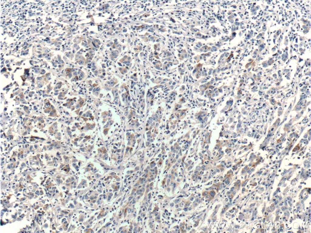 IHC staining of human stomach cancer using 67849-1-Ig