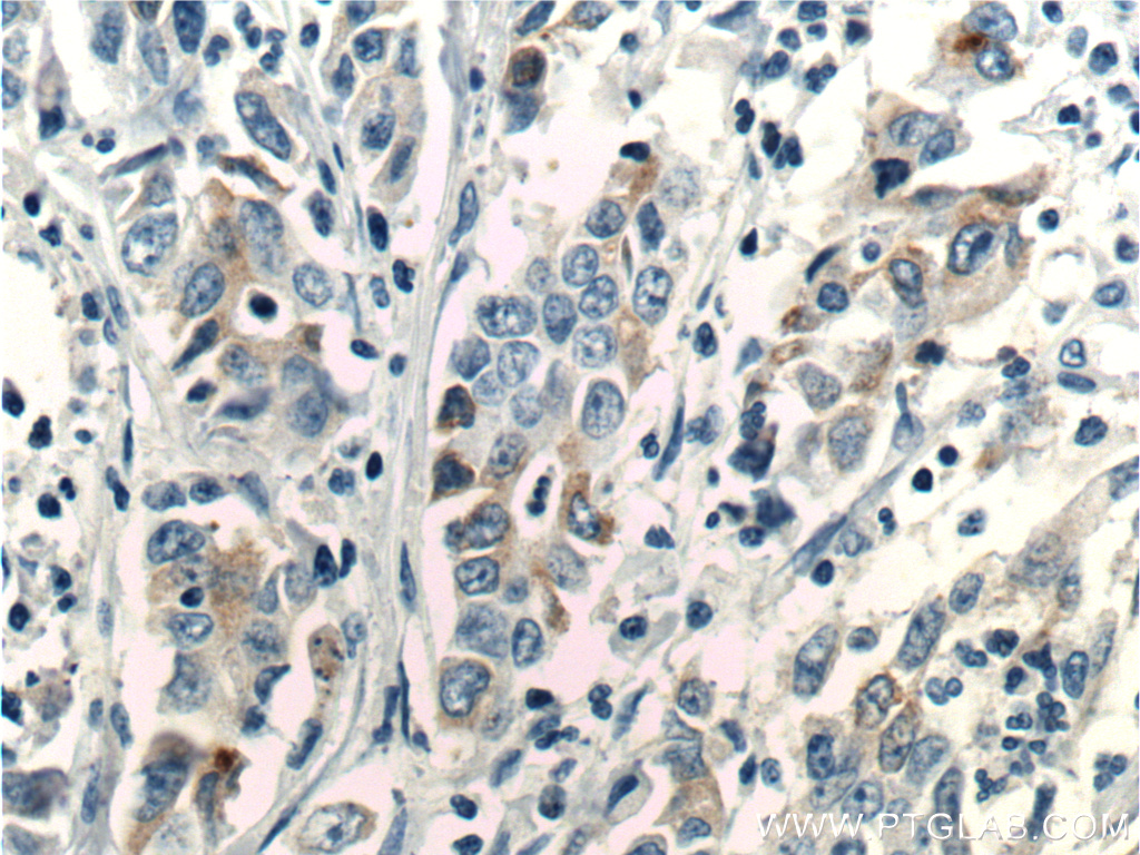 IHC staining of human stomach cancer using 67849-1-Ig