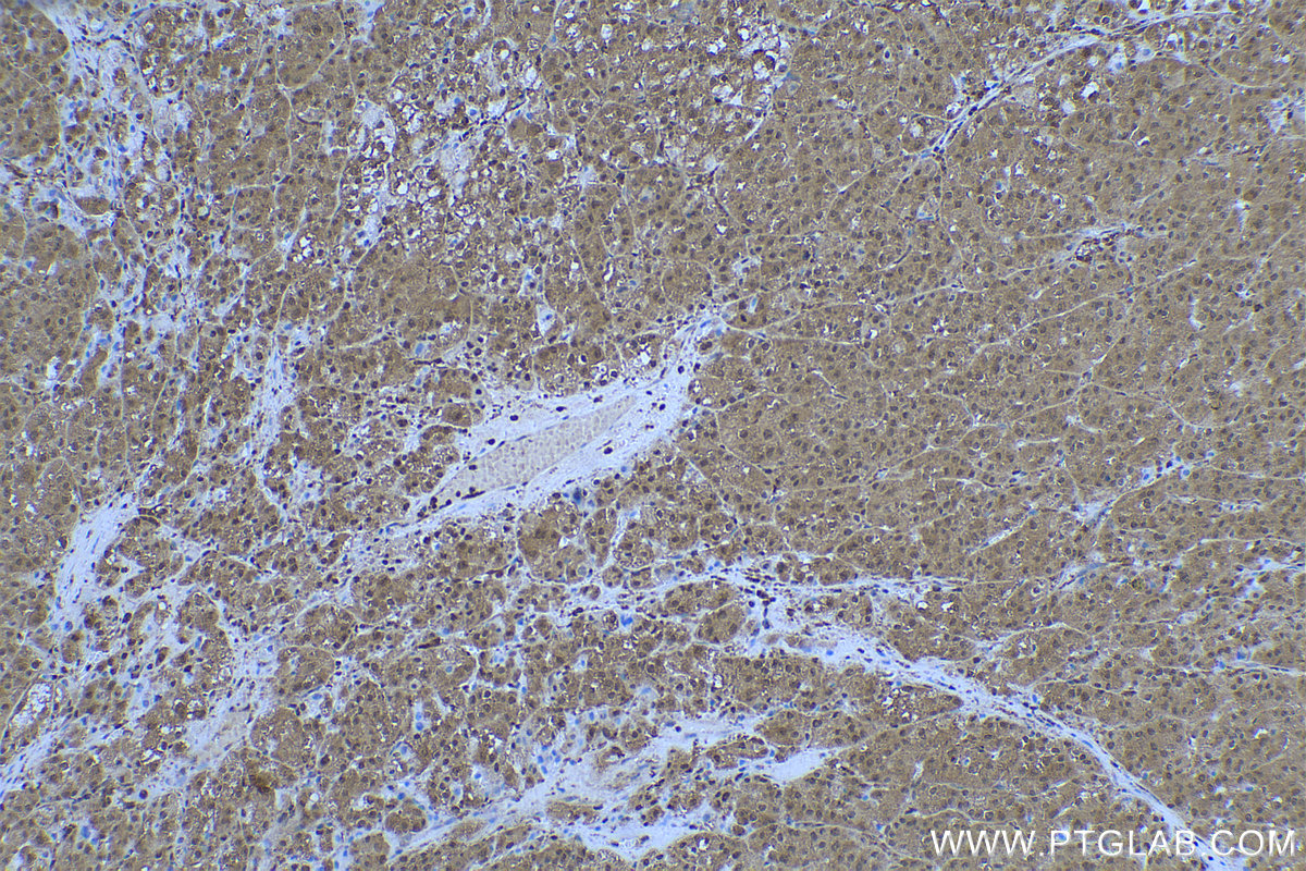 IHC staining of human liver cancer using 68035-1-Ig (same clone as 68035-1-PBS)
