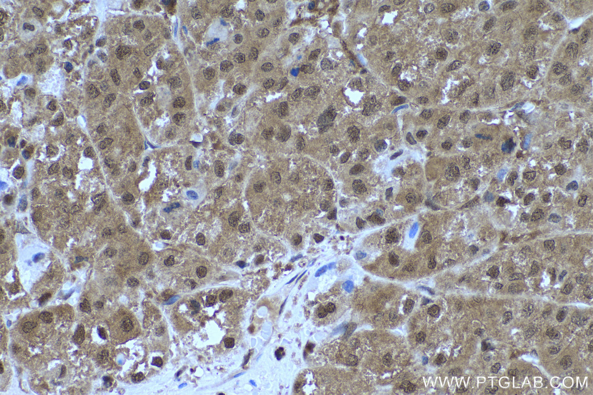 IHC staining of human liver cancer using 68035-1-Ig (same clone as 68035-1-PBS)