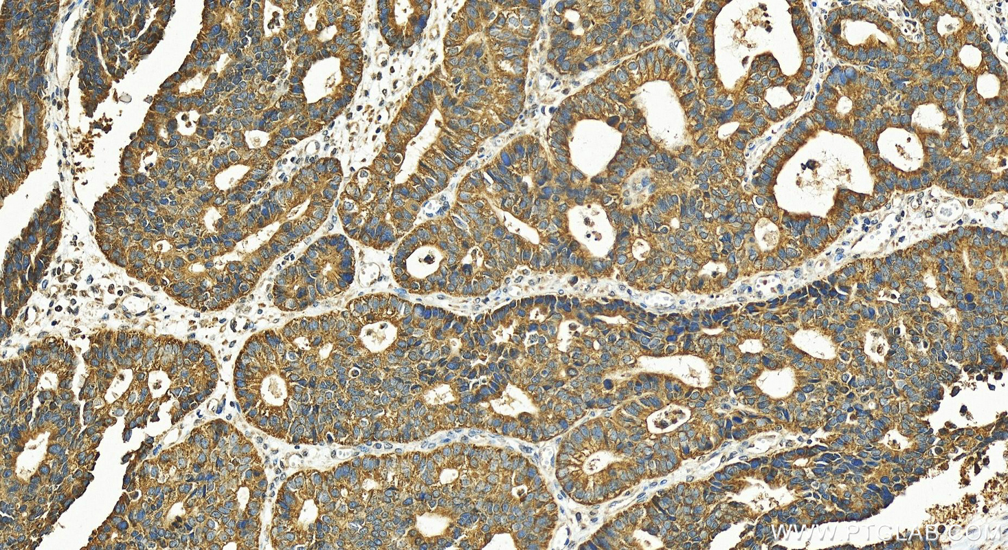 IHC staining of human stomach cancer using 30434-1-AP