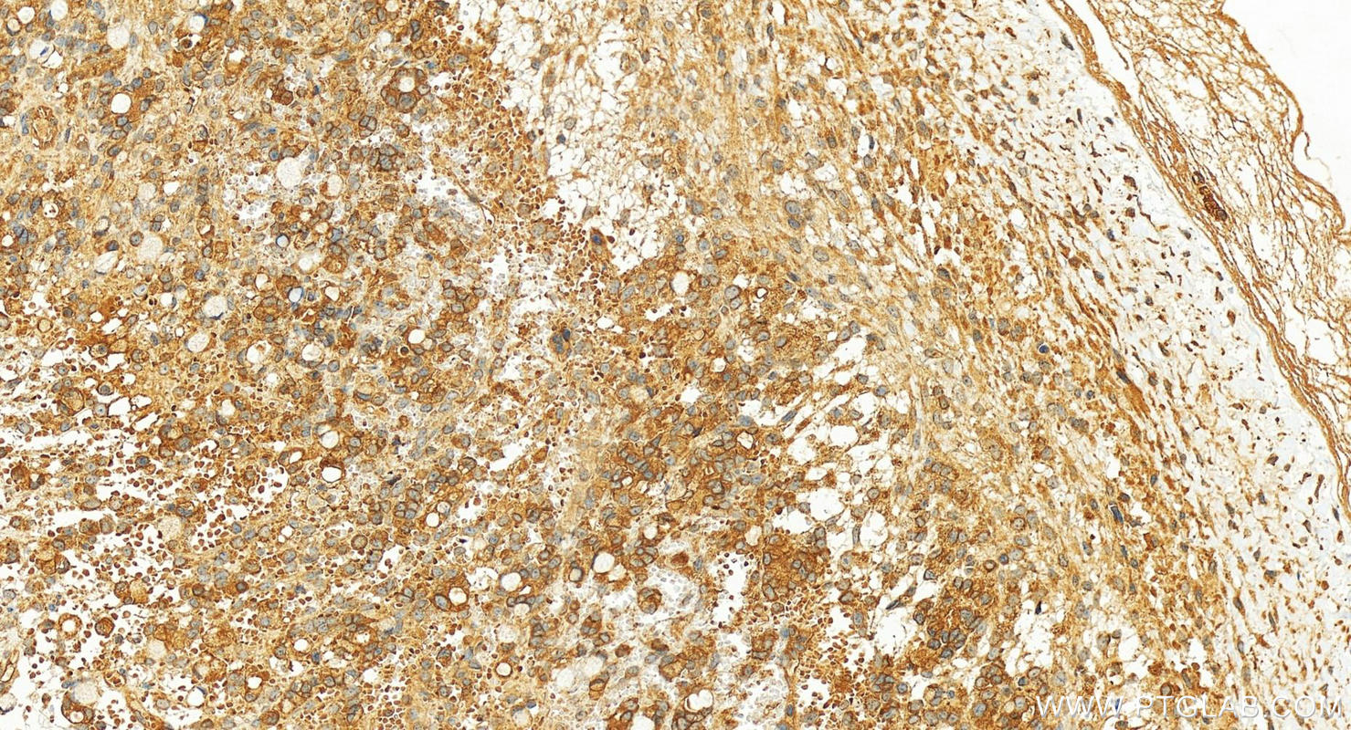 IHC staining of human ovary cancer using 13408-1-AP