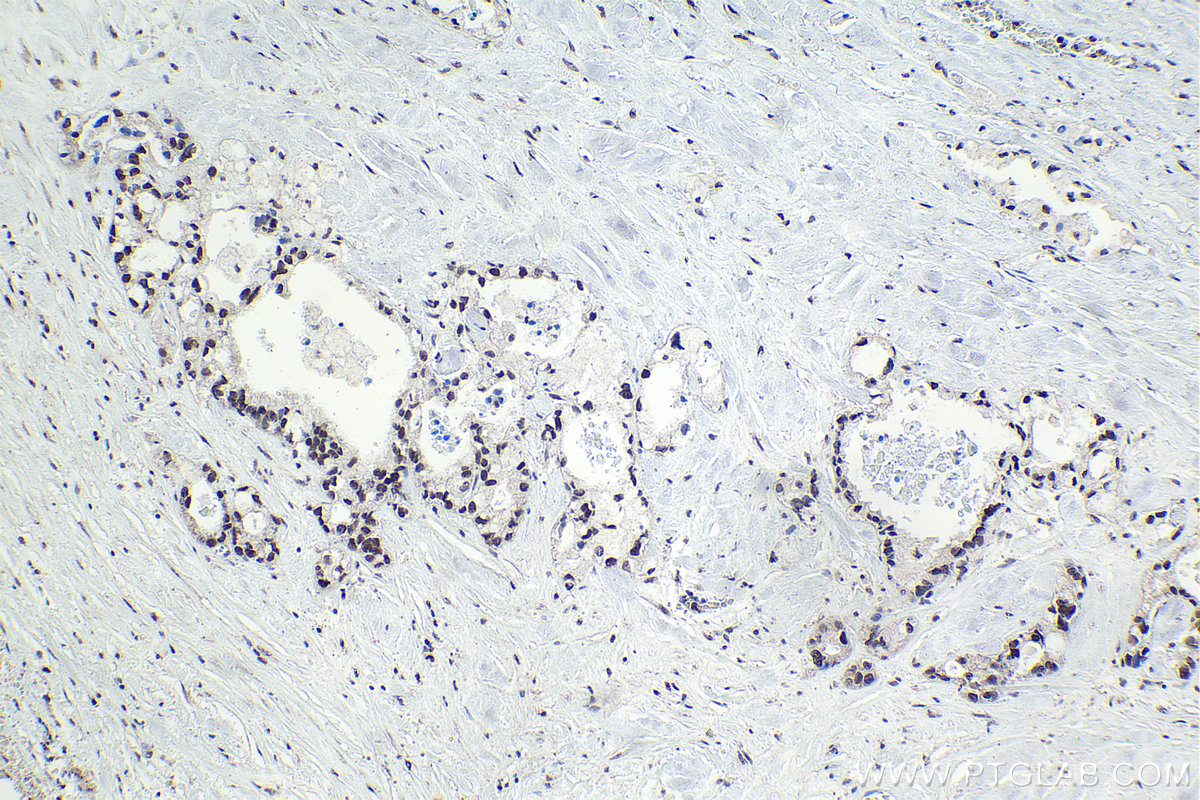 IHC staining of human pancreas cancer using 12867-1-AP