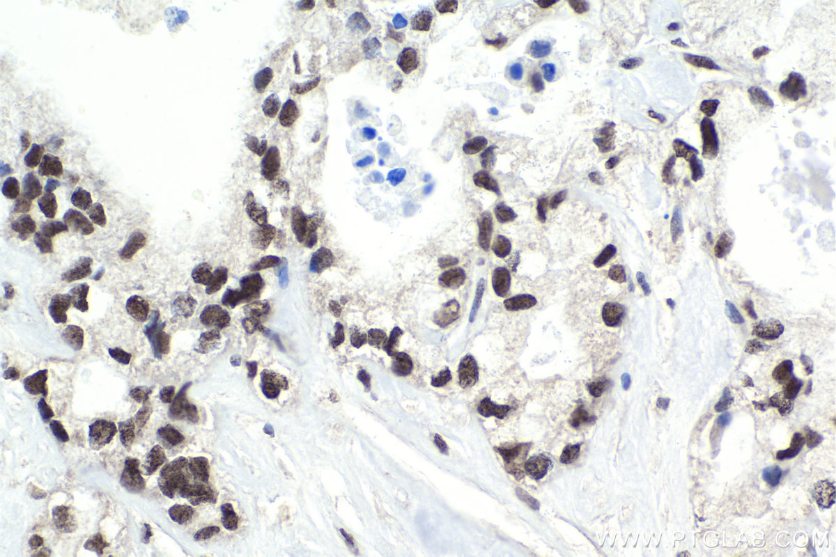 IHC staining of human pancreas cancer using 12867-1-AP