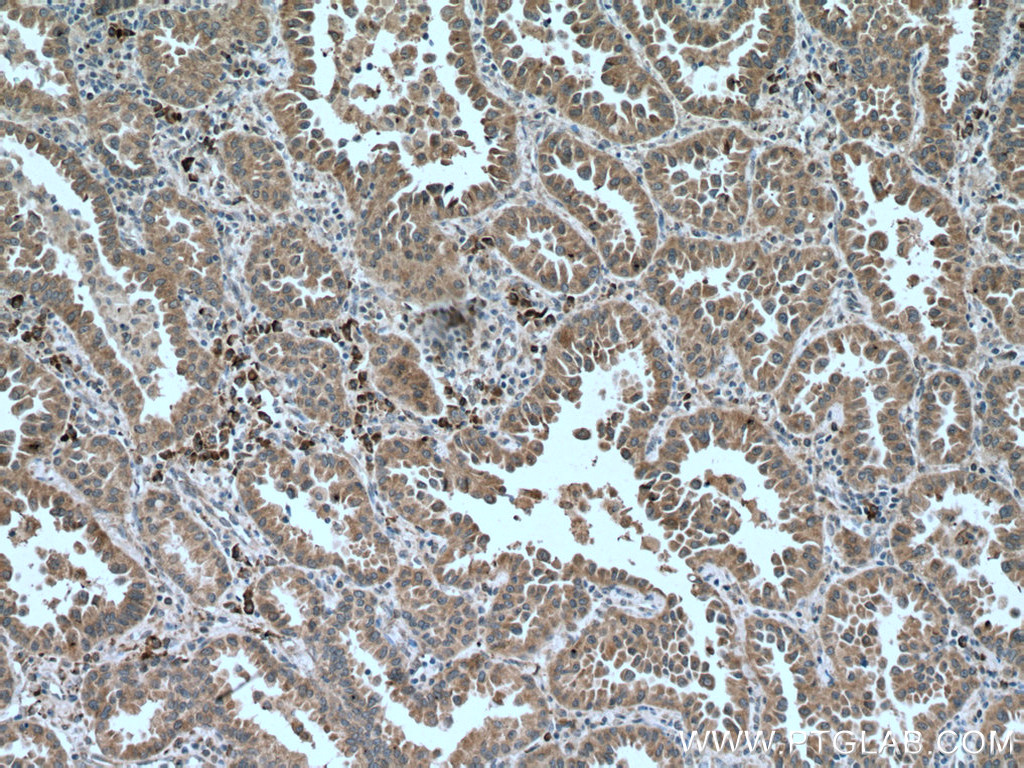 IHC staining of human lung cancer using 66934-1-Ig (same clone as 66934-1-PBS)