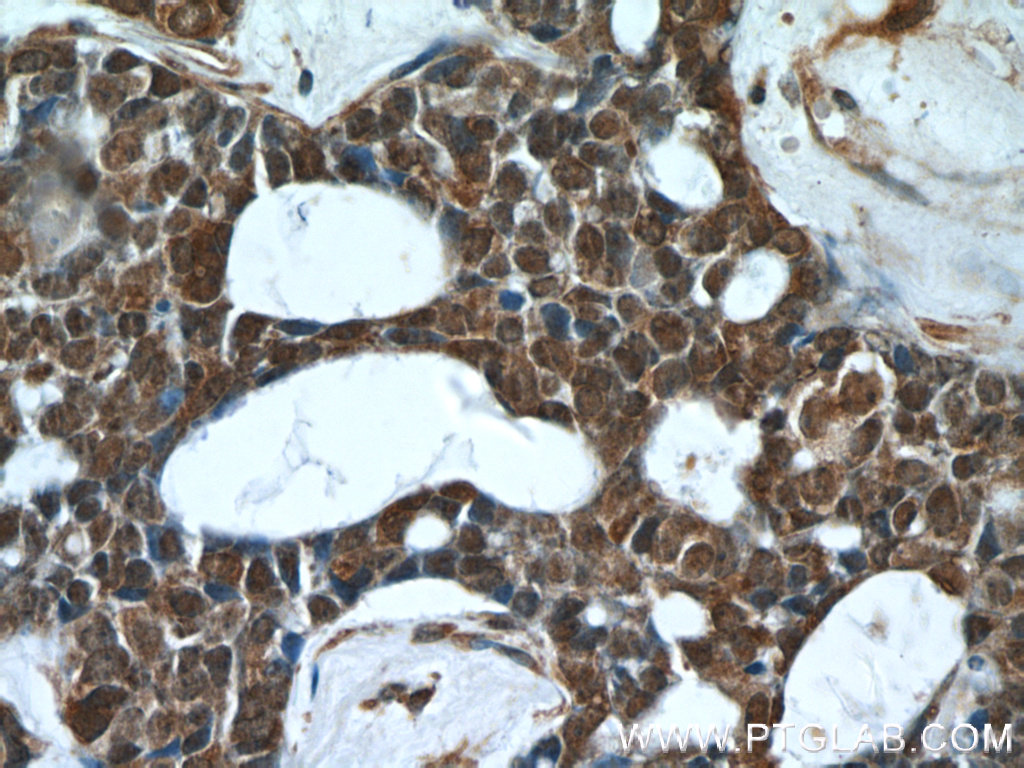 IHC staining of human cervical cancer using 24624-1-AP