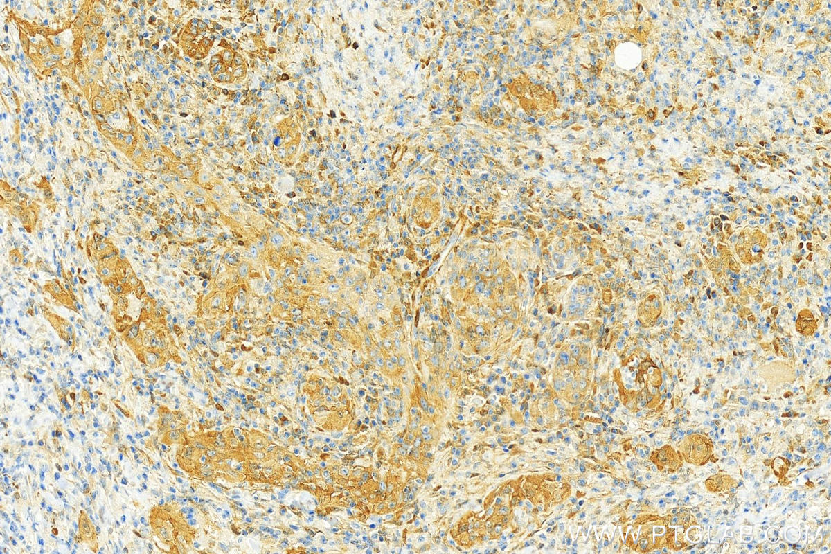 IHC staining of human skin cancer using 18263-1-AP