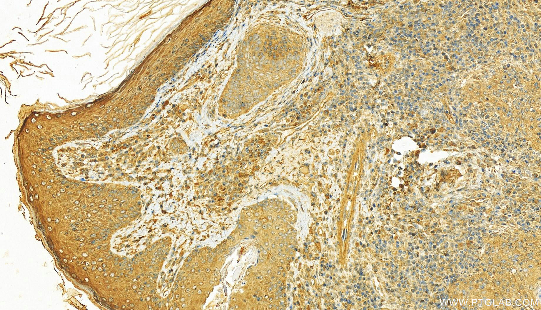 IHC staining of human skin cancer using 27940-1-AP