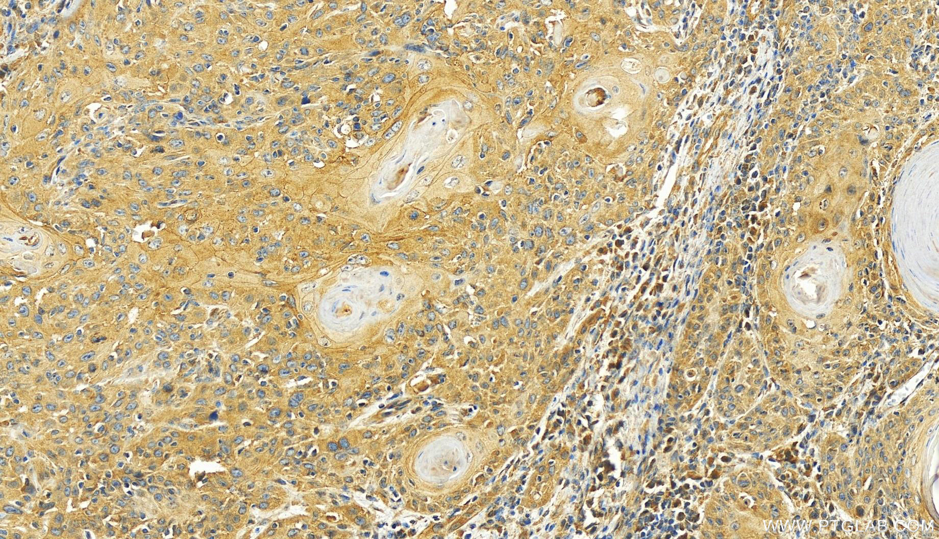 IHC staining of human skin cancer using 27940-1-AP