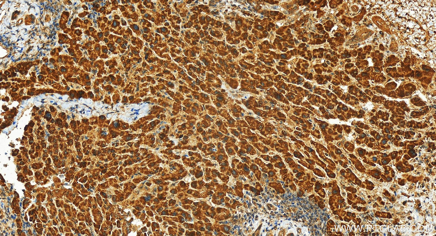 IHC staining of human intrahepatic cholangiocarcinoma using 14413-1-AP