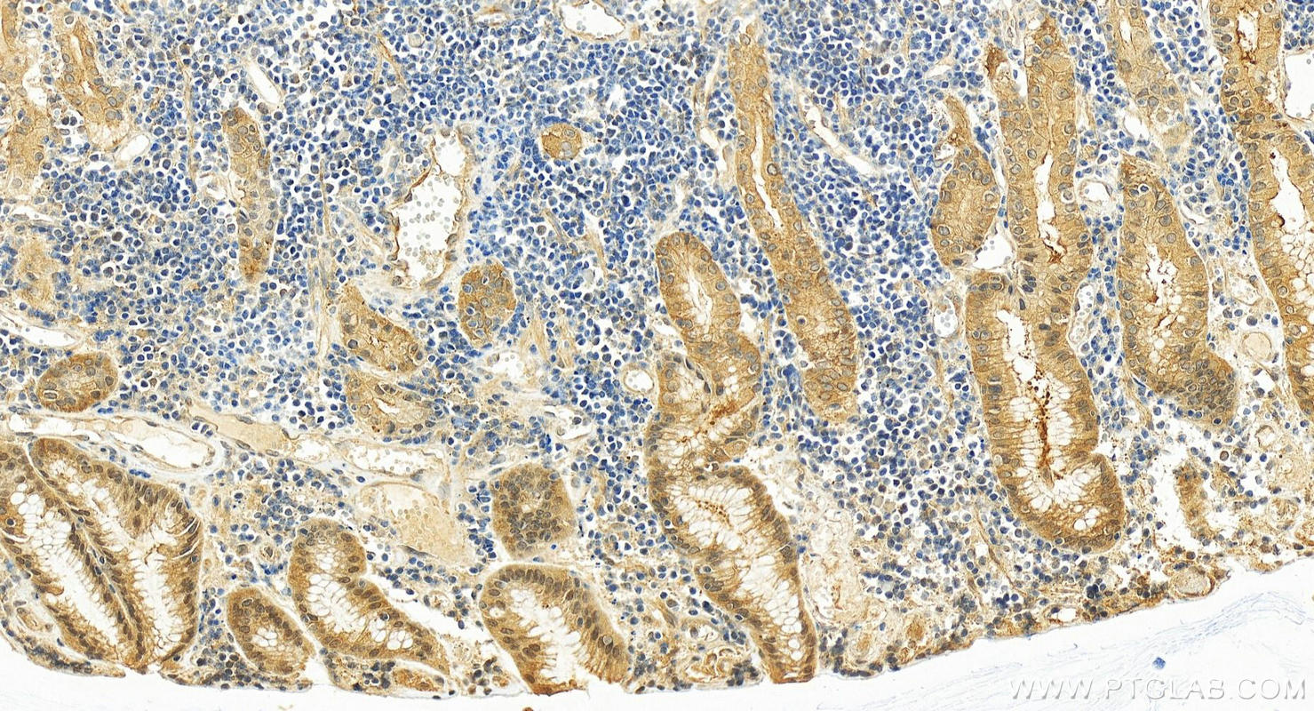 IHC staining of human stomach cancer using 82919-1-RR