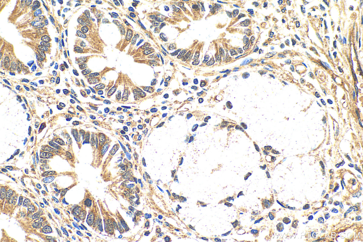 IHC staining of human stomach cancer using 82919-1-RR (same clone as 82919-1-PBS)