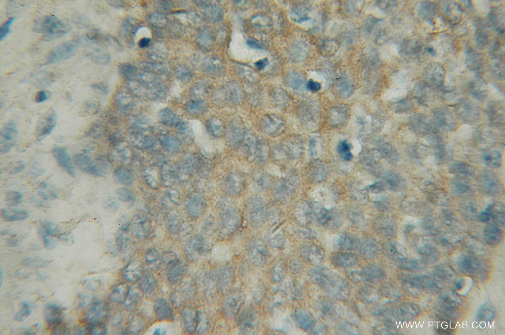 IHC staining of human prostate cancer using 12612-1-AP (same clone as 12612-1-PBS)