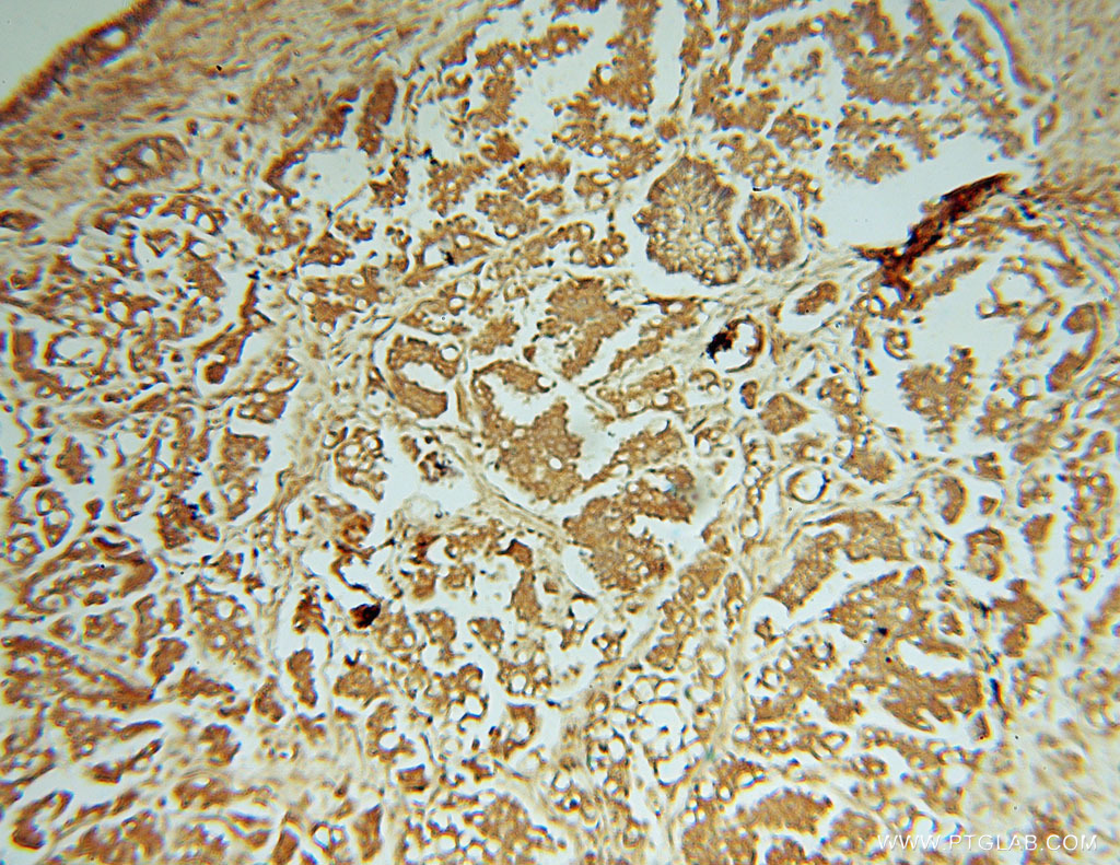 IHC staining of human ovary tumor using 15151-1-AP