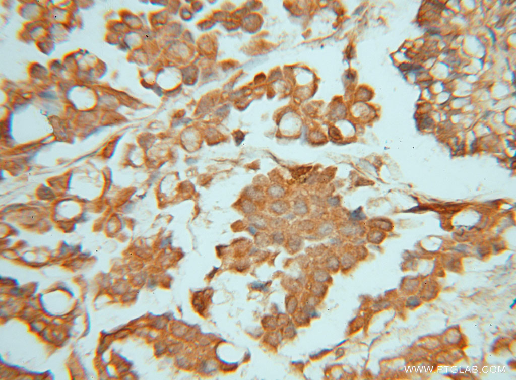 IHC staining of human ovary tumor using 15151-1-AP