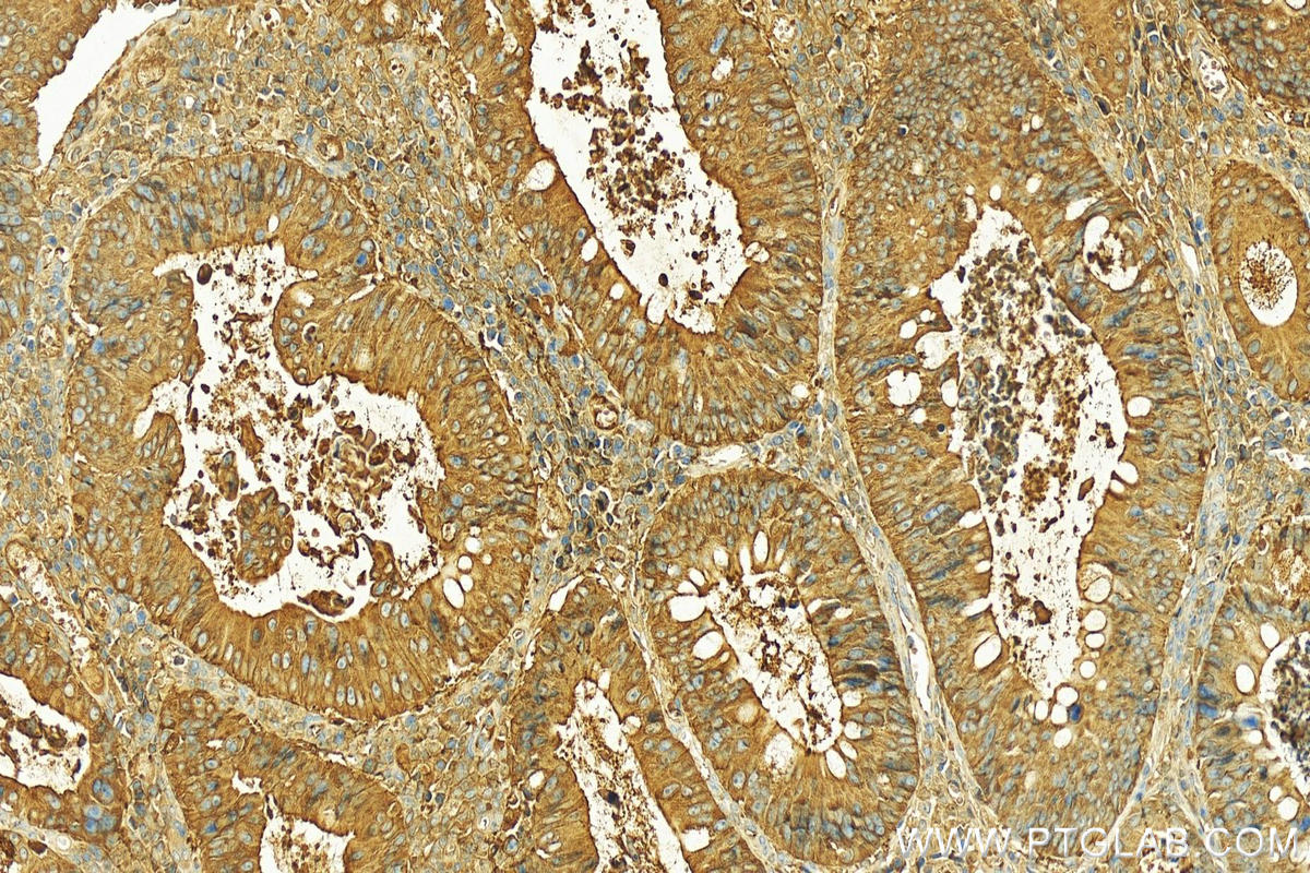 IHC staining of human colon cancer using 22024-1-AP