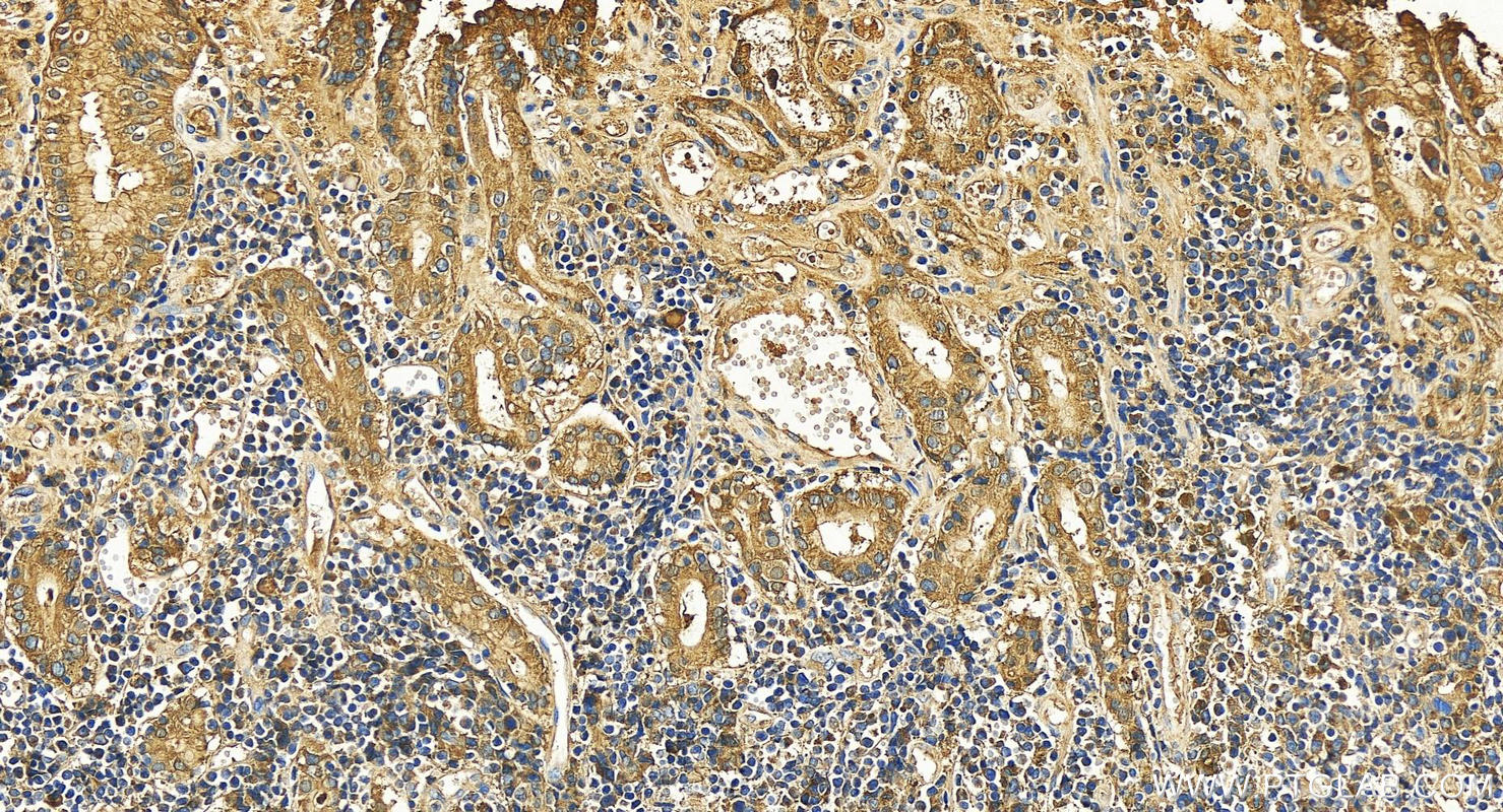 IHC staining of human stomach cancer using 22024-1-AP