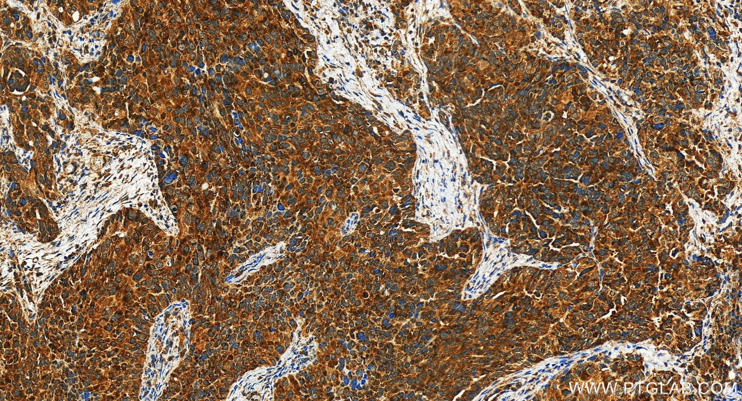 IHC staining of human ovary cancer using 31229-1-AP