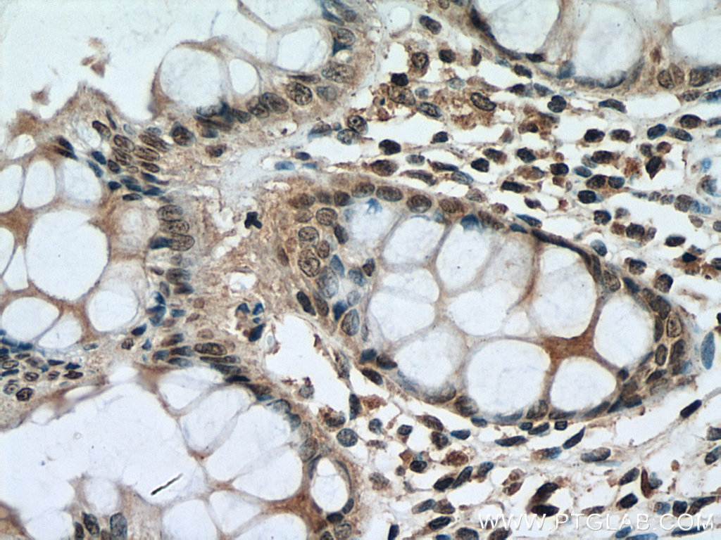 IHC staining of human colon using 67644-1-Ig (same clone as 67644-1-PBS)