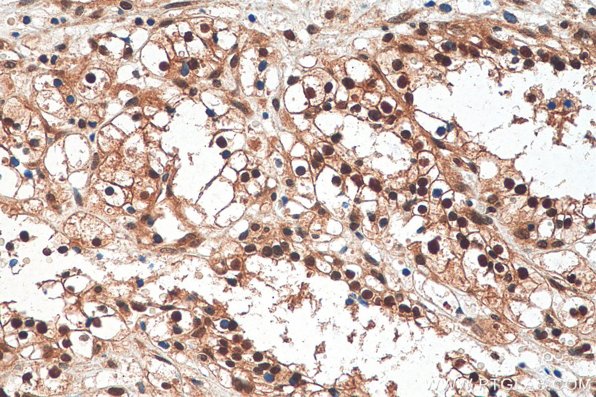 IHC staining of human renal cell carcinoma using 10495-1-AP