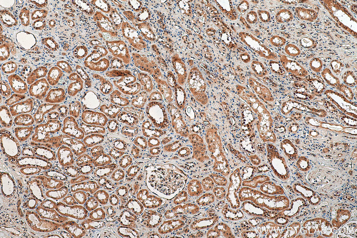 IHC staining of human renal cell carcinoma using 10495-1-AP