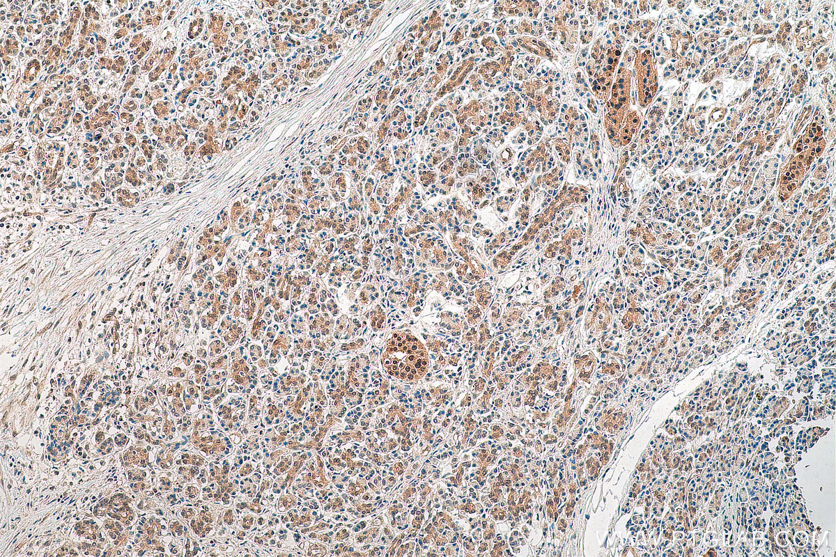 IHC staining of human pancreas cancer using 10495-1-AP