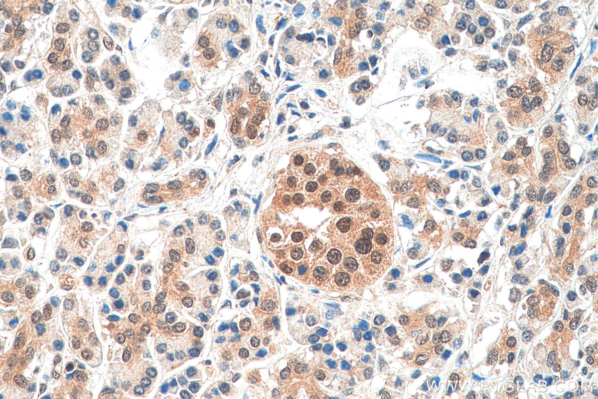 IHC staining of human pancreas cancer using 10495-1-AP