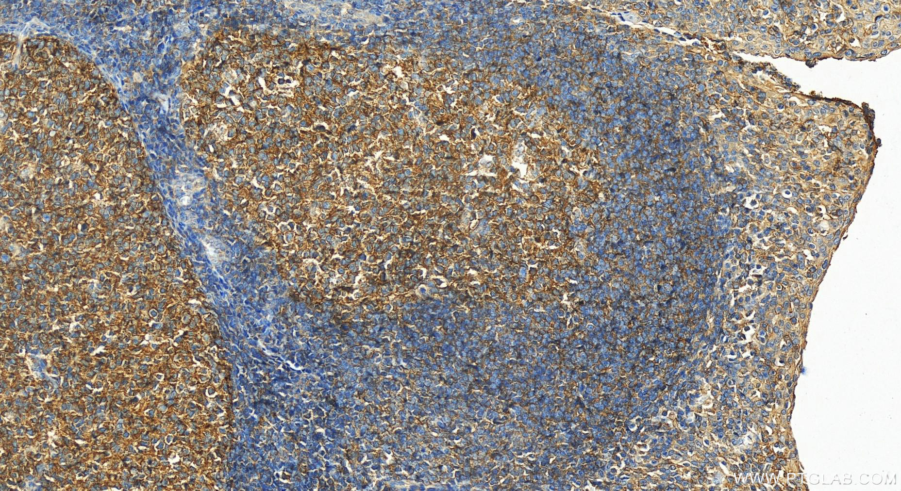 IHC staining of human tonsillitis using 15713-1-AP