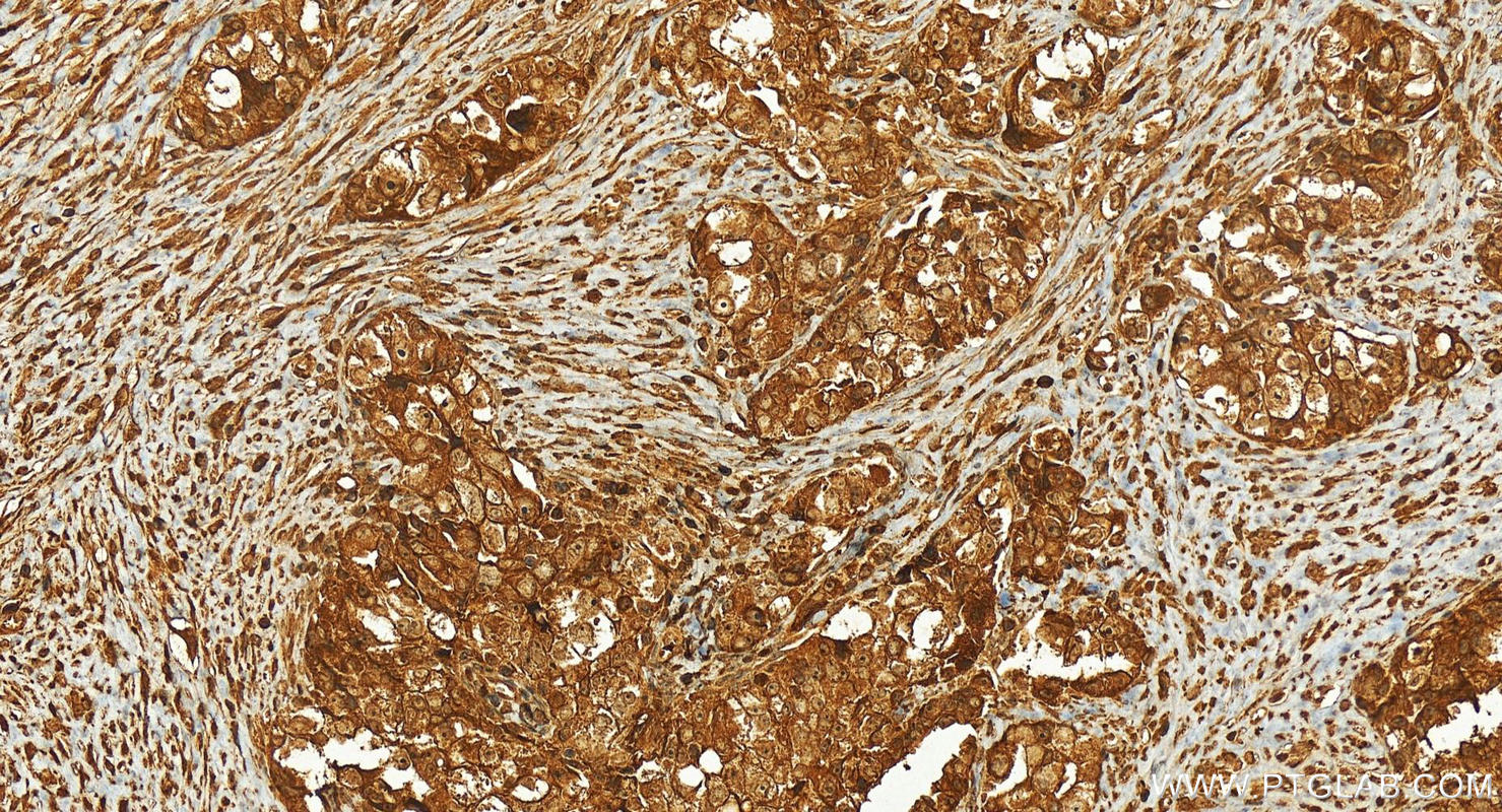 IHC staining of human ovary cancer using 26899-1-AP