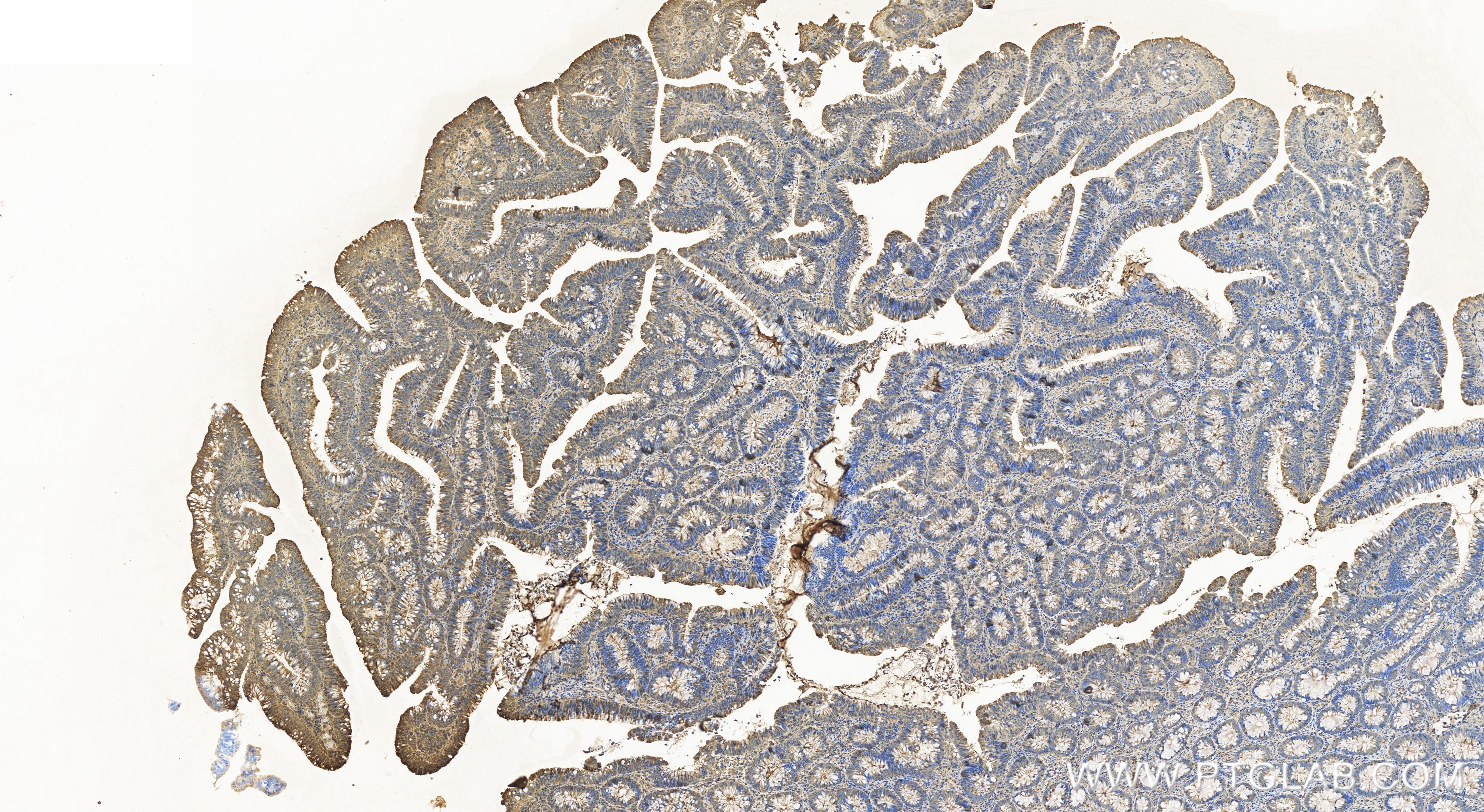 IHC staining of human colon cancer using 84451-1-RR