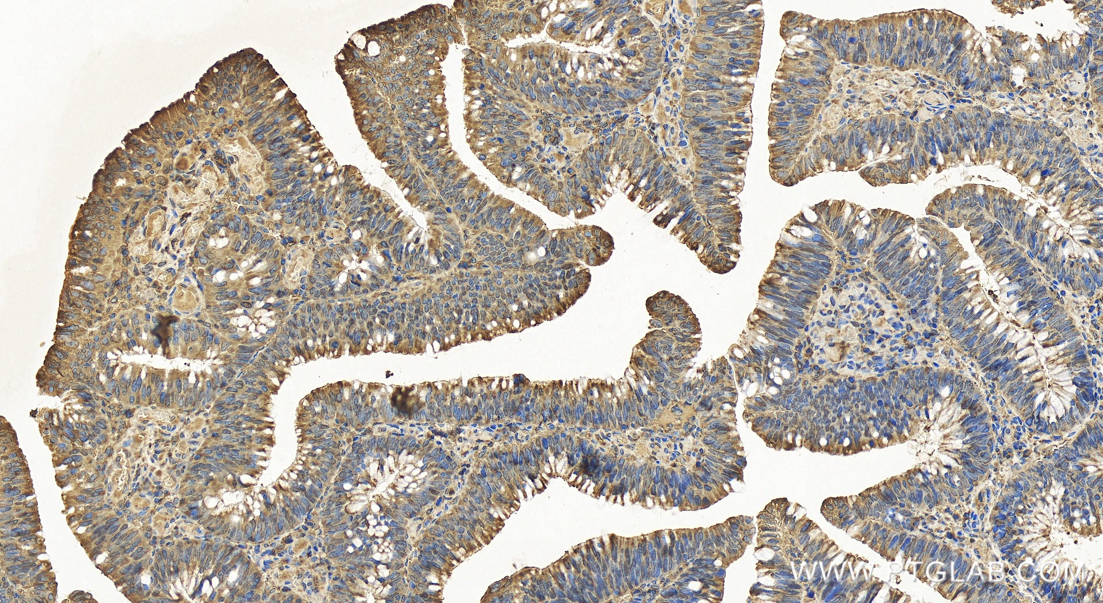 IHC staining of human colon cancer using 84451-1-RR