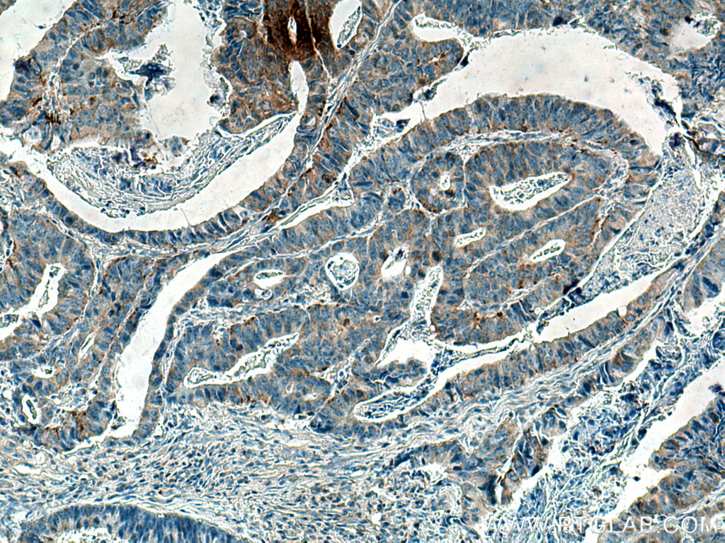 IHC staining of human colon cancer using 67806-1-Ig (same clone as 67806-1-PBS)
