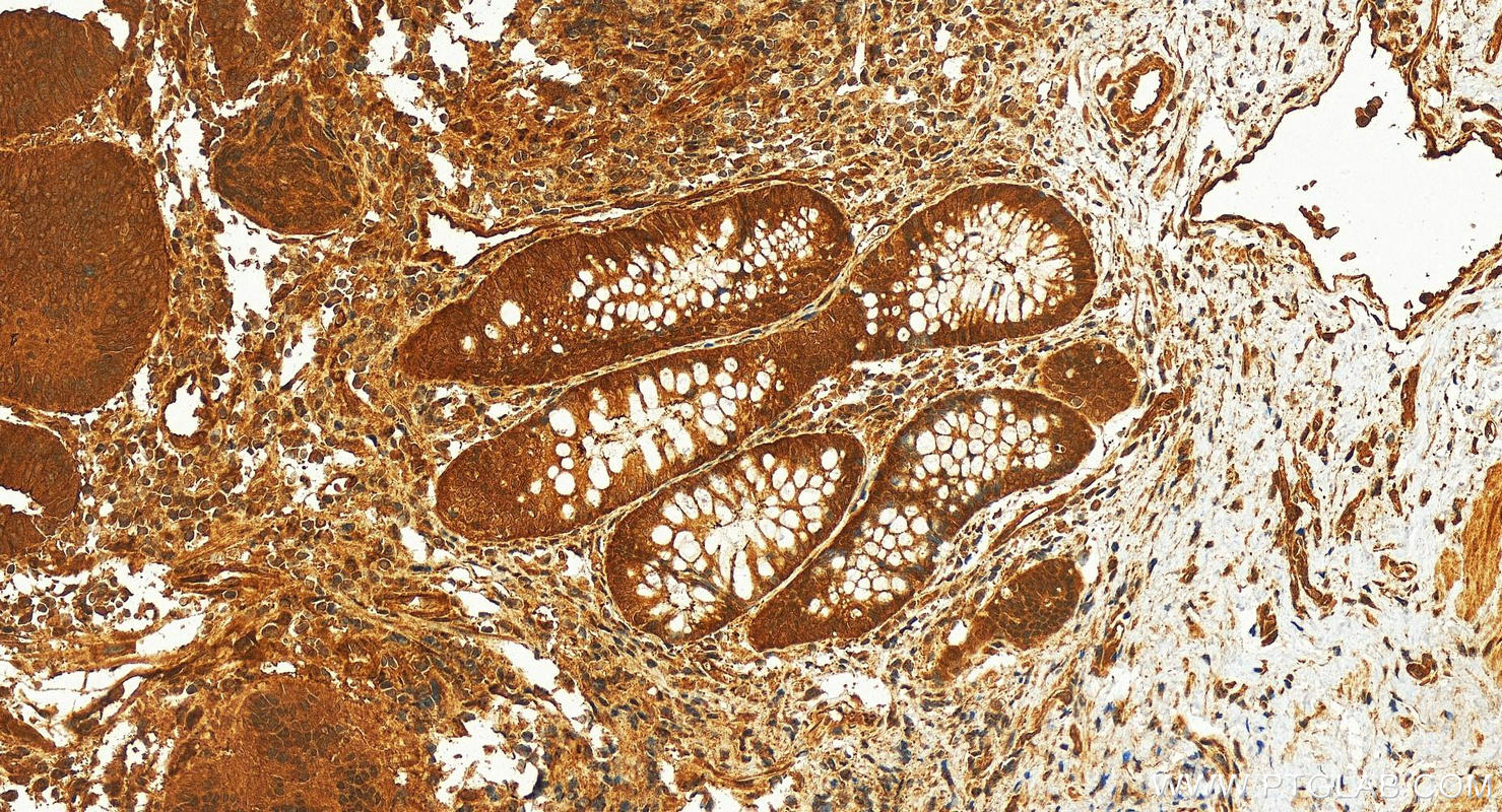 IHC staining of human colon cancer using 14608-1-AP